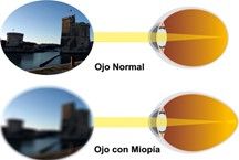 SINTOMAS DE LA MIOPIA