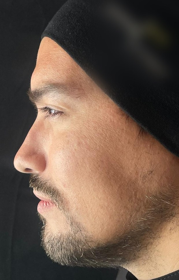 Perfil nasal antes de la rinomodelación