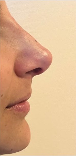 Perfil nasal después de la rinomodelación
