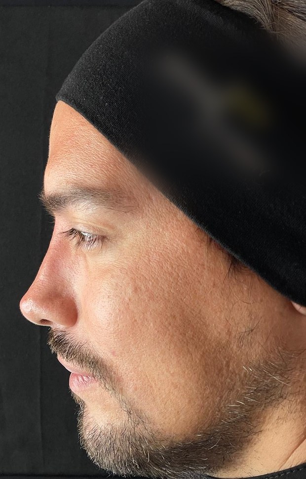 Perfil nasal después de la rinomodelación