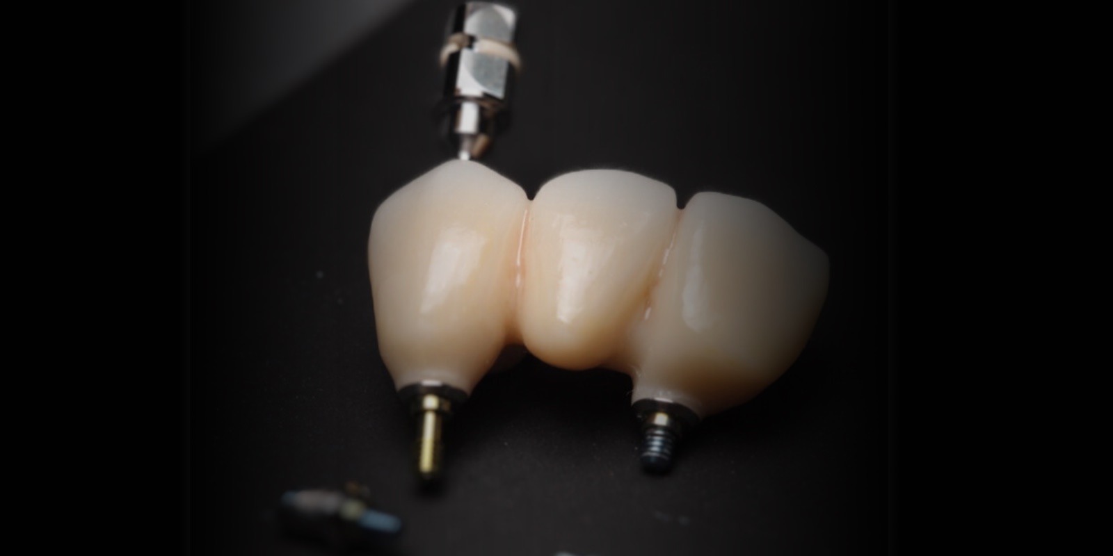 Prótesis fija de tres piezas sobre implantes de titanio, con los pilares a la vista