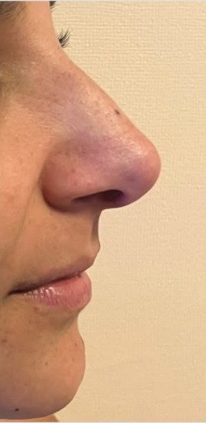 Perfil nasal antes de la rinomodelación