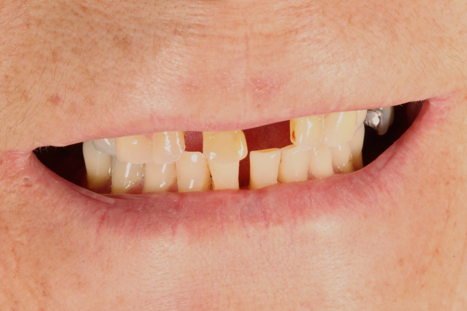 Antes: dientes desgastados y piezas perdidas de un paciente de Som Clinic